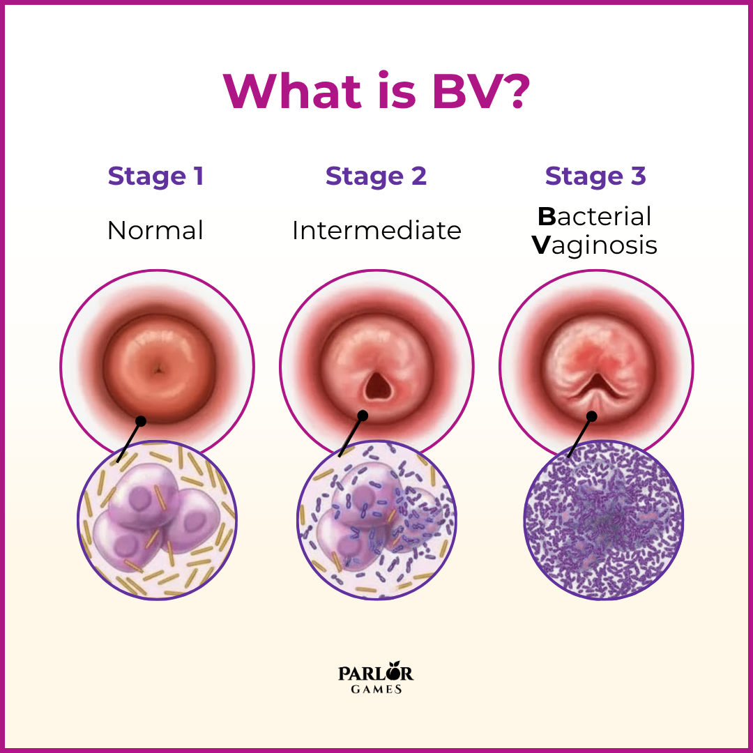 Picture of Accessories, Earring, Jewelry with text What is BV? Stage 1 Stage 2 Stage 3 Bacterial Nor...